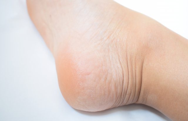 水虫と症状が似ている病気