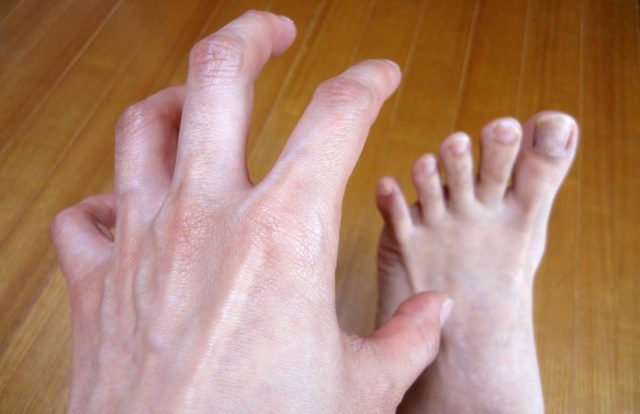水虫かなと思ったら