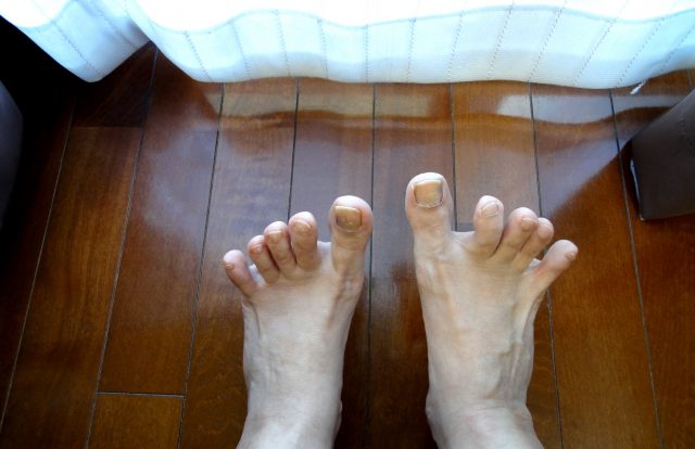 爪水虫は再発しますか