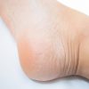 水虫と症状が似ている病気